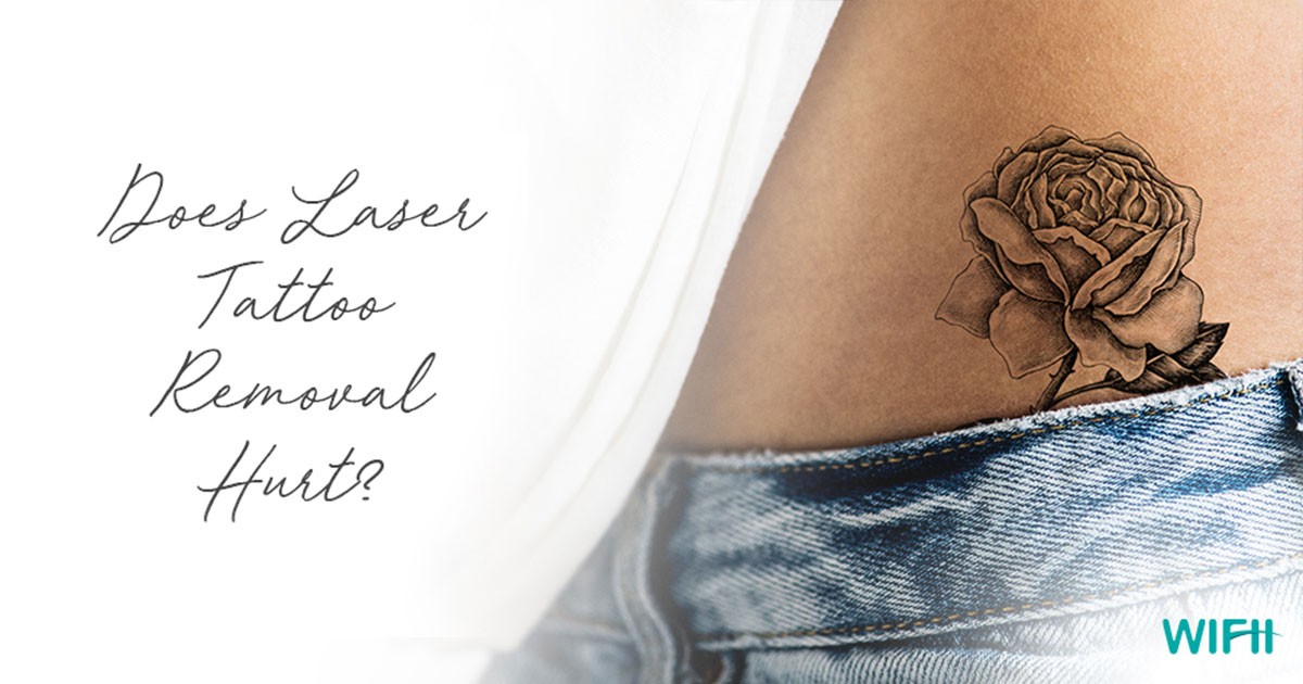 Does Laser Tattoo Removal Hurt? | WIFH