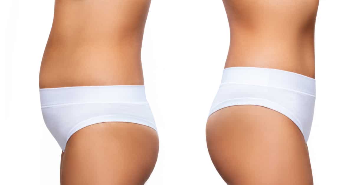 What Is The Difference Between Lipo And Lipo 360? - Blog