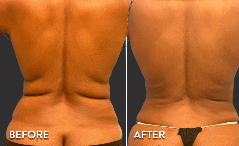 Smartlipo Before & After Pictures