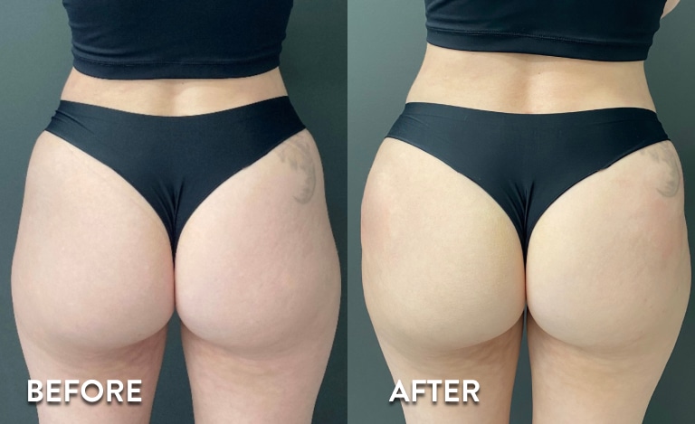 Sculptra BBL Non Surgical Butt Lift Before and After Pictures
