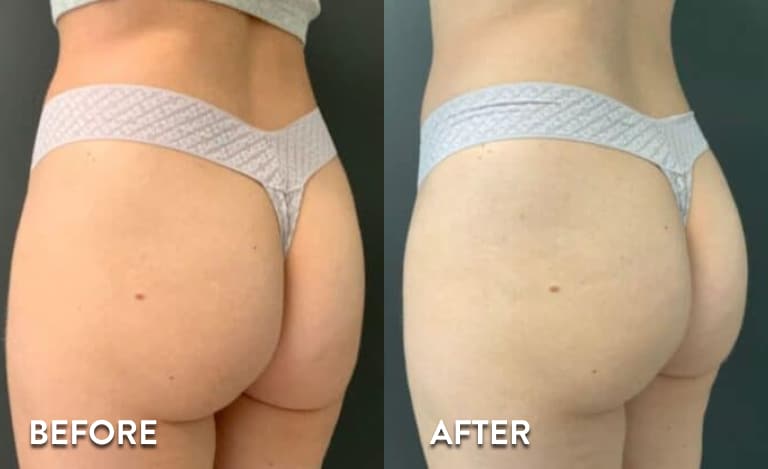Sculptra BBL Non Surgical Butt Lift Before and After Pictures